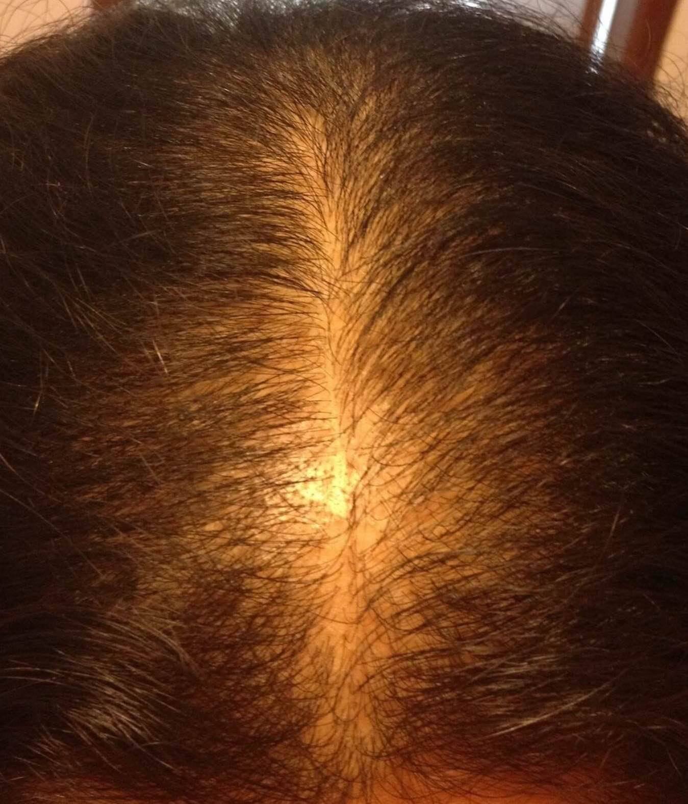 Our Hair Loss Diet Completely Reverses Hair Thinning And Balding