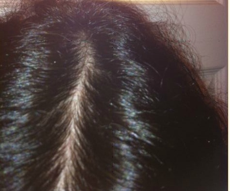 DeeDee's hair regrowth picture top view