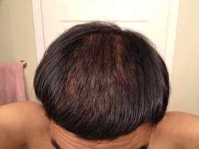 Brian S Before And After Hair Regrowth Pictures