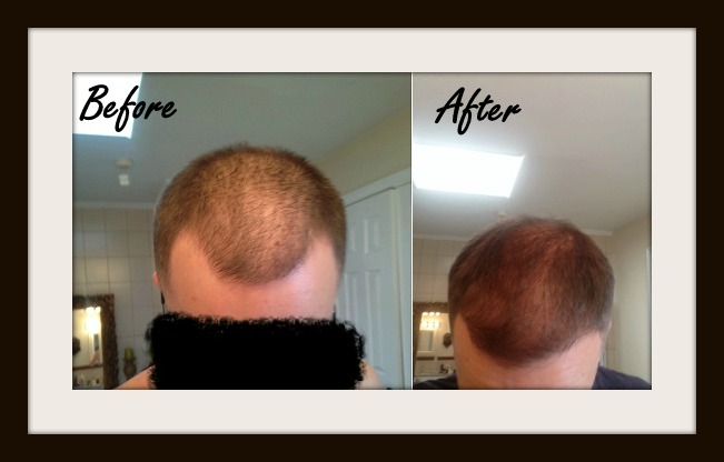 Our Hair Loss Diet Completely Reverses Hair Thinning Balding