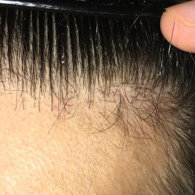 Andrew S Exciting Hair Regrowth Story